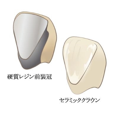 セラミッククラウンの基本情報 3 セラミッククラウン11