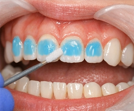 Tooth surface etching