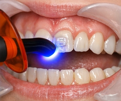 Light-curing to set the bracket
