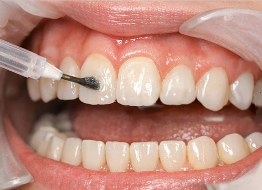 Applying the primer (bonding agent)