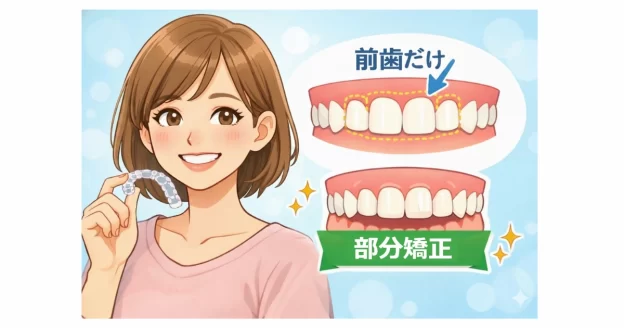 前歯だけ矯正 マウスピース 部分矯正のイメージ