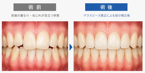 前歯の叢生、軽度なケース