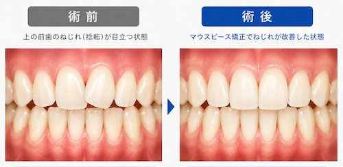 前歯の叢生、やや重度なケース