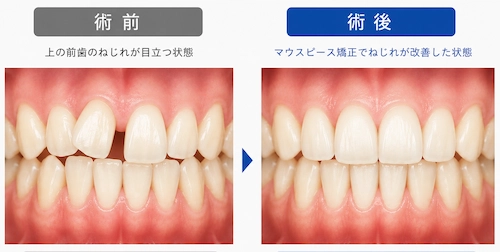 前歯のすきっ歯とねじれ