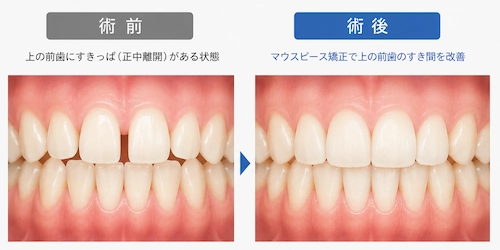 前歯のすきっ歯