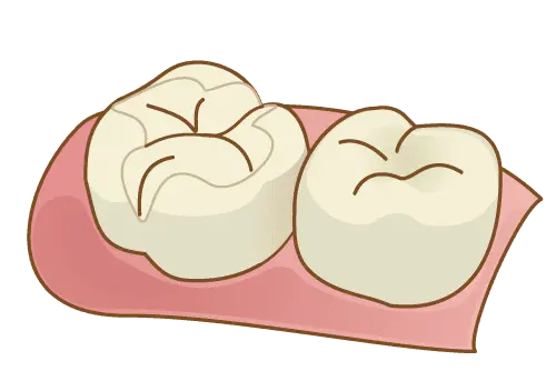 レジンインレーのイラスト