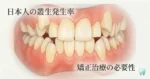 叢生発生率と矯正治療の必要性
