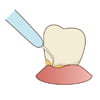 歯根表面を滑沢にするルートプレーニングという処置のイラストです（アイキャッチ画像）。