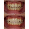前歯２本はセラミッククラウン、ほかはホワイトニングで整えた治療の写真です（アイキャッチ画像）。