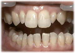 歯のすきま治療後の状態