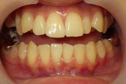 変色歯,治療前の状態