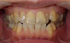 歯のねじれや重なりをセラミッククラウンで改善した写真、治療前