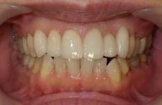 歯のねじれや重なりをセラミッククラウンで改善した写真、治療後