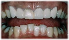 セラミッククラウン２３