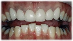 セラミッククラウン２４