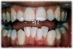 セラミッククラウン２６