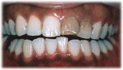 セラミッククラウン２７