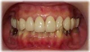 ラミネートベニア１５