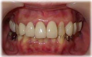 ラミネートベニア１６