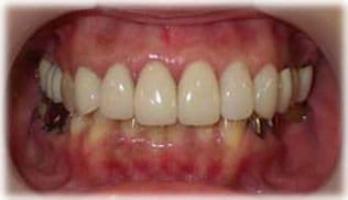 ラミネートベニア１７