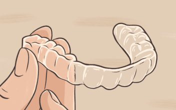 マウスピース矯正