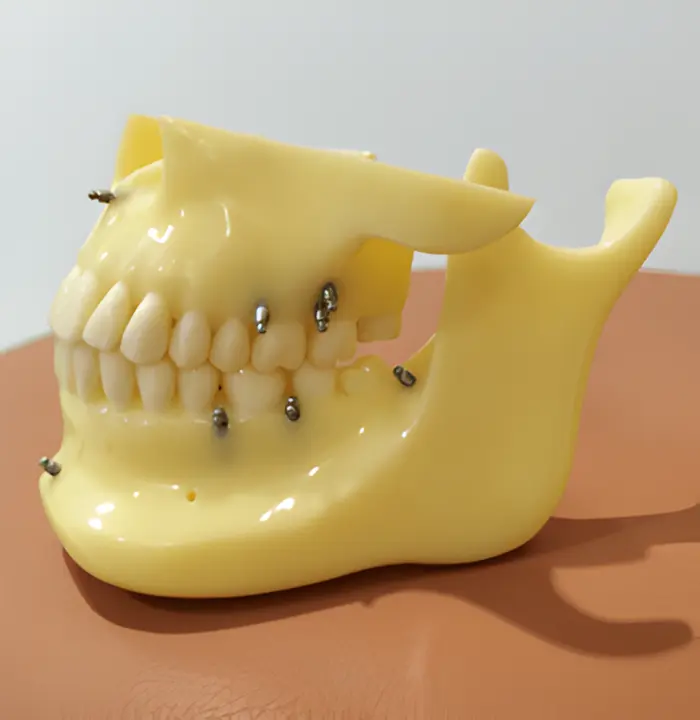 アンカースクリューサンプル