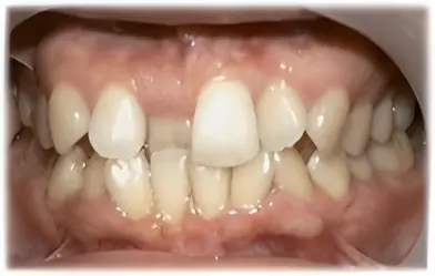 部分矯正・術前