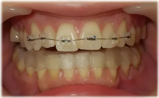 前歯の部分矯正・バイトアップ