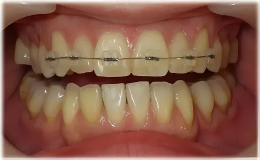 前歯の部分矯正・途中