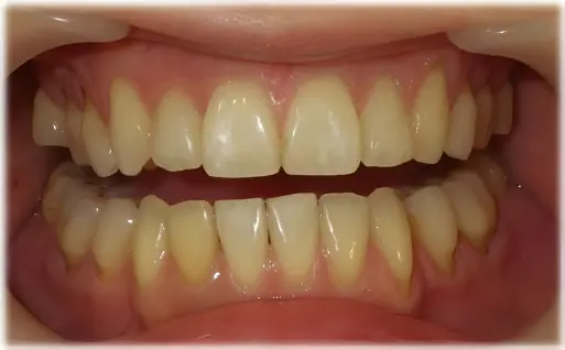 前歯の部分矯正・装置除去