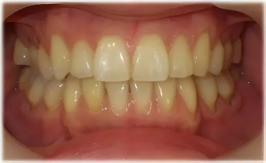 前歯の部分矯正・術後
