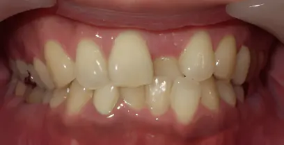 部分矯正・術前