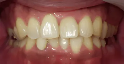 部分矯正・術後