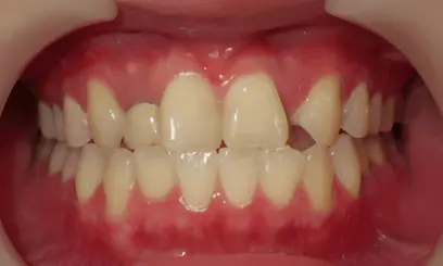 部分矯正・術前