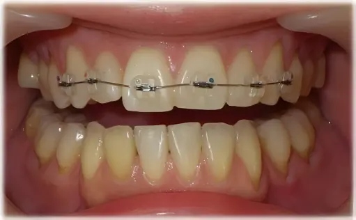 前歯の部分矯正・装置装着