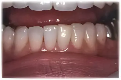 ウォーキングブリーチ・術後