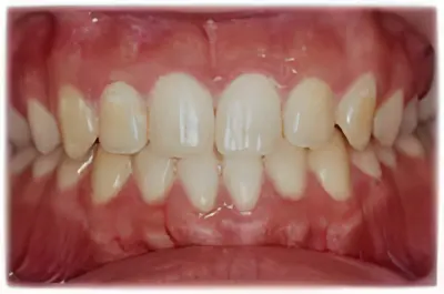 ホワイトニング・術前