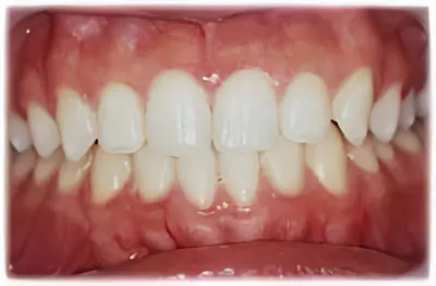 ホワイトニング・術後