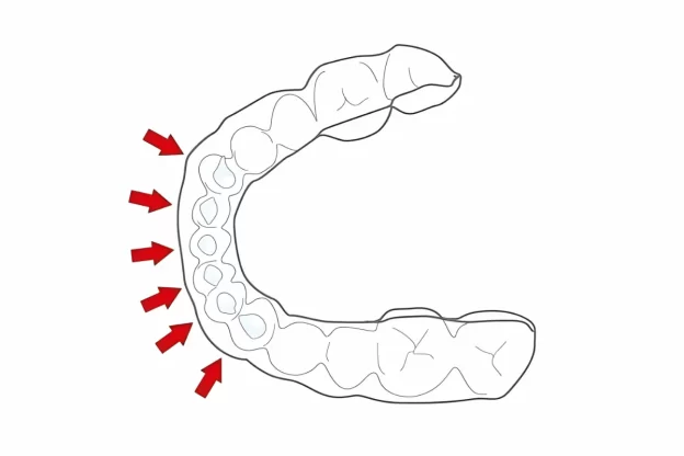 ホワイトニング用マウスピース