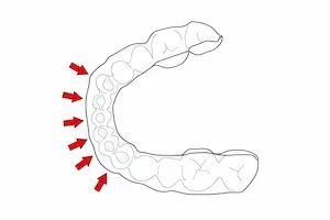 ホワイトニング用マウスピース