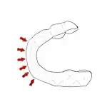 ホワイトニング用マウスピース