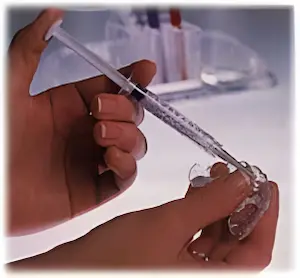 ホワイトニング・ジェル注入のようす