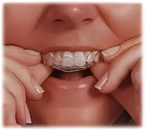 ホワイトニングのマウスピースを装着