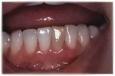 ウォーキングブリーチ・術前