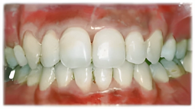 全体的な歯列不正_術後