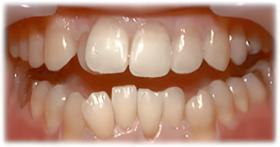 全体的な歯列不正_術前