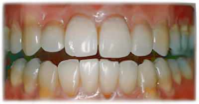 全体的な歯列不正_術後