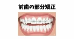 前歯の部分矯正