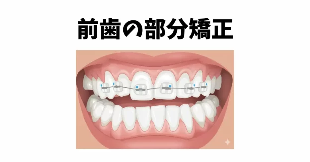 前歯の部分矯正