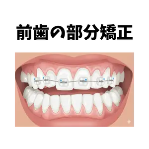 前歯の部分矯正